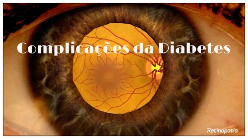 Complicações da Diabetes – Complicações Microvasculares